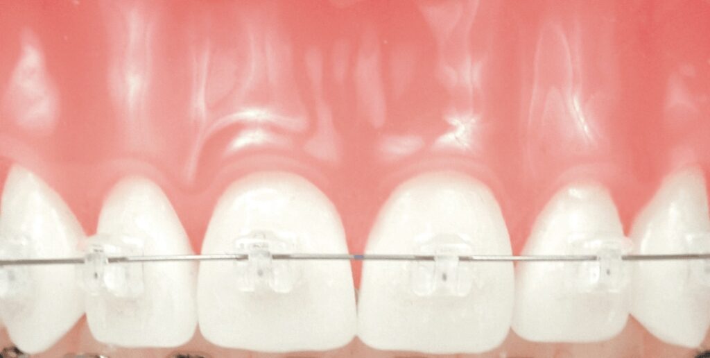 formal social barrier Aparatul dentar Damon autoligaturant - Clinica Dental Practice