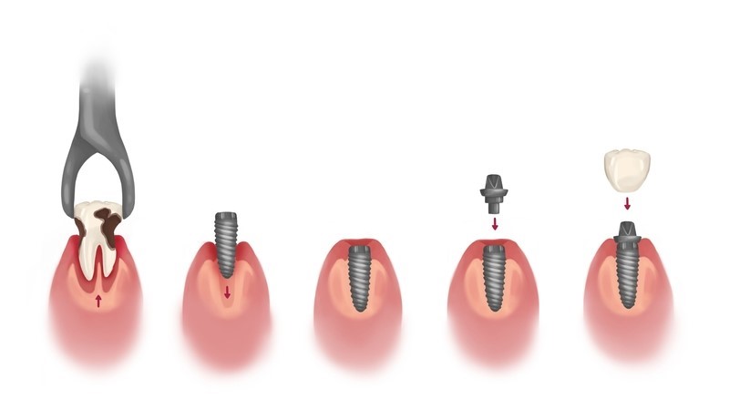 Etapele tratamentului cu implant dentar
